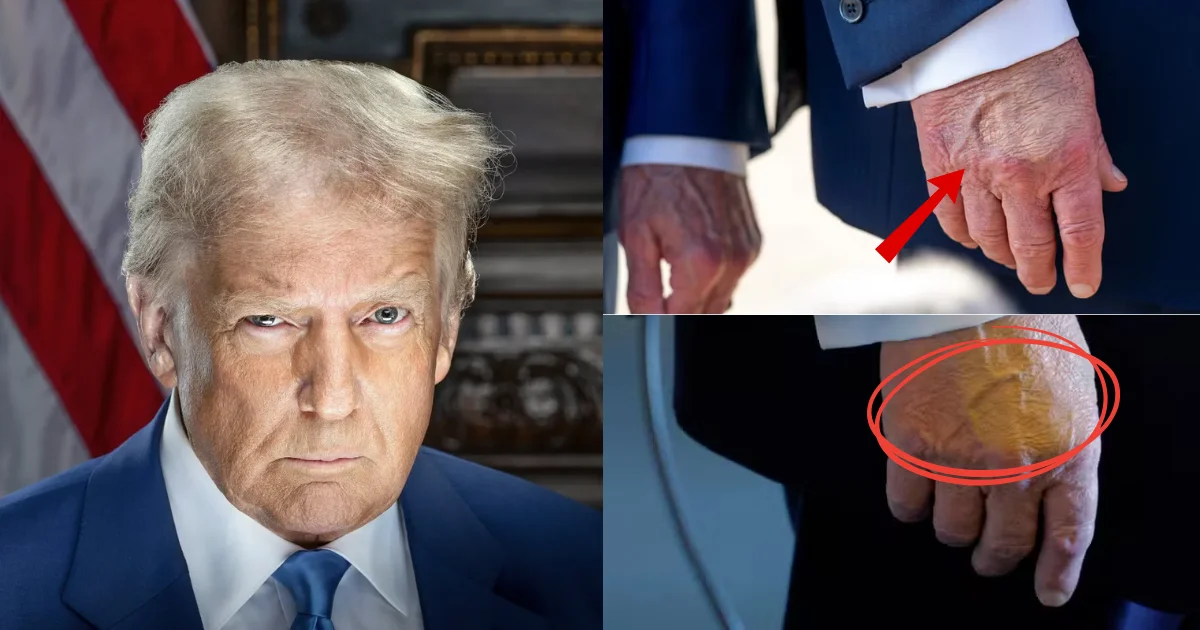As manchas na mão de Donald Trump têm um significado assustador e pouca gente percebeu.
